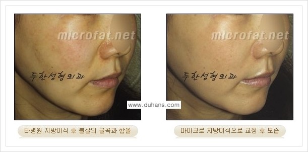 [두한성형외과 경쟁력 윤곽성형] - [볼, 볼살 지방이식] 관련 이미지 37