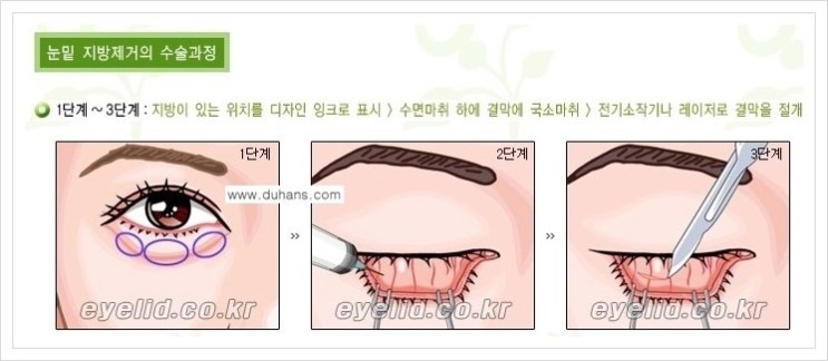 [두한성형외과 경쟁력 지방제거] - [윗눈꺼풀 지방제거, 아랫 눈꺼풀 지방제거  안내 2.] 관련 이미지 3