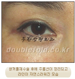 [두한성형외과 쌍수] - [재수술 실패의 원인, 재수술의 성공 요건] 관련 이미지 17