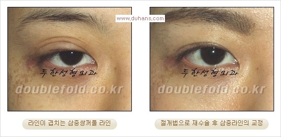 [두한성형외과 경쟁력 쌍꺼풀 재수술] - [삼중(세겹) 쌍꺼풀 라인, 눈꺼풀이 함몰된 삼중(세겹) 쌍꺼풀 라인 교정] 관련 이미지 3