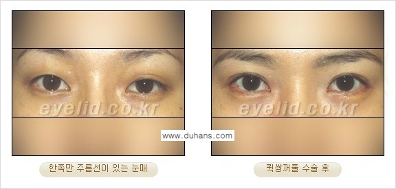 [두한성형외과 성형 FOCUS] - [퀵쌍꺼풀 수술 ②] 관련 이미지 6