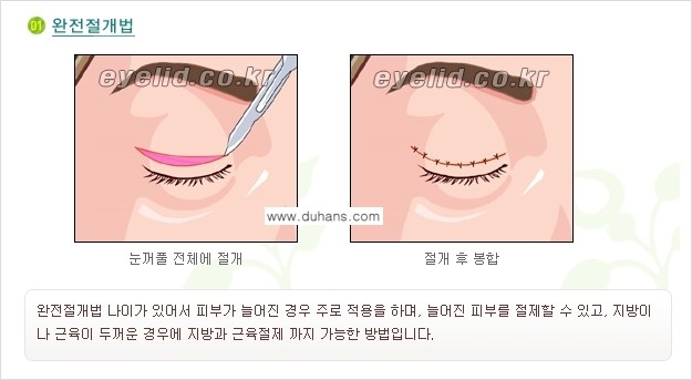 [두한성형외과 성형 FOCUS] - [퀵쌍꺼풀 수술 ①] 관련 이미지 3