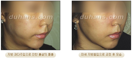[두한성형외과 얼굴자가지방이식] - [볼살, 이마, 측두부] 관련 이미지 44