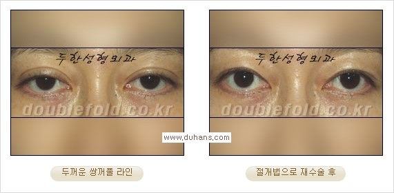 [두한성형외과 경쟁력 쌍꺼풀 재수술] - [쌍꺼풀 재수술 과정] 관련 이미지 70