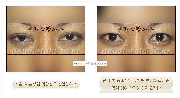 ⁠⁠[두한성형외과 경﻿쟁력 쌍꺼풀 재수술] - [안검하수(졸리운 눈매) 종류와 교정 방법 안내] 관련 이미지 7