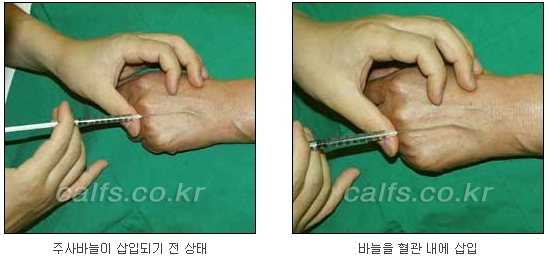 두한성형외과 보기싫은 혈관제거 - 눈밑혈관, 손과 팔의 혈관확장증 치료 관련 이미지 25