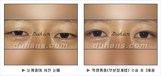[두한성형외과 쌍커풀수술] - [눈성형 방법에 대한 자주하는 질문과 답변] 관련 이미지 130