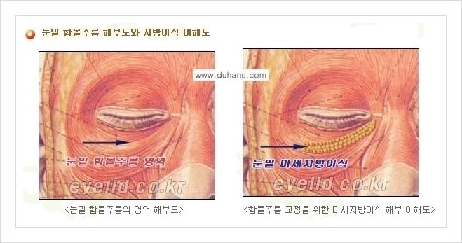 [두한성형외과 경쟁력 눈밑성형] - [눈밑 미세지방이식으로 다크써클 치료] 관련 이미지 5