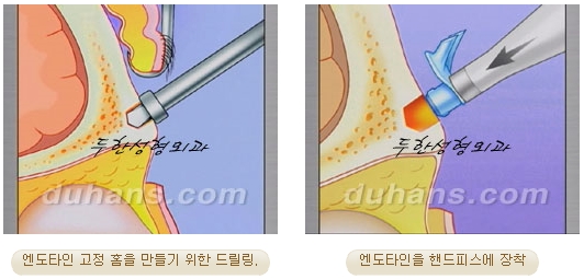 두한성형외과 안티에이징 리프팅 - 엔도타인 리프팅 관련 이미지 34