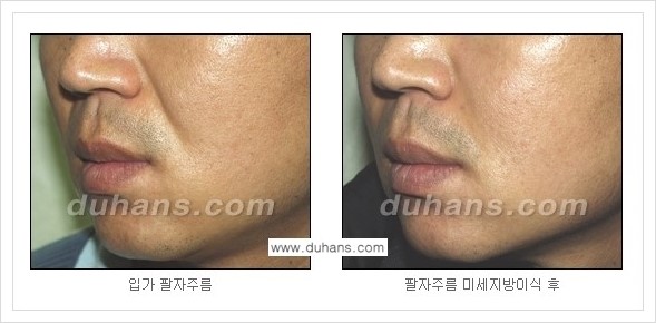[두한성형외과 경쟁력 주름성형] - [코 옆과 입가에 걸쳐서 형성된 주름을 교정해주는 미세지방이식] 관련 이미지 18