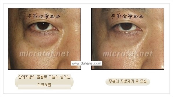 [두한성형외과 경쟁력 눈밑성형] - [눈밑지방제거, 눈위지방제거 안내 2.] 관련 이미지 13
