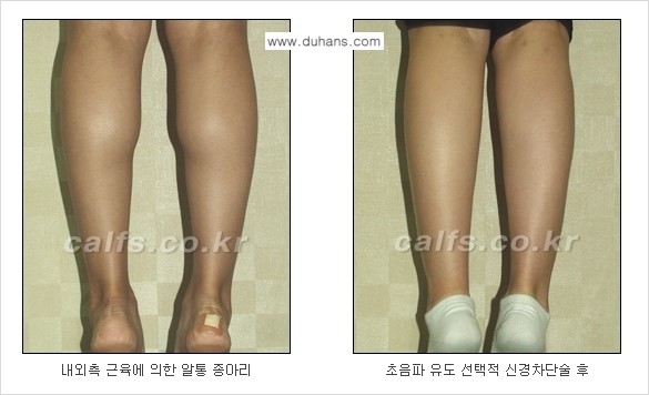 ​[두한성형외과와 날씬한 종아리 만들기!] - [간편하고 안전한 종아리 축소방법 ④] 관련 이미지 12