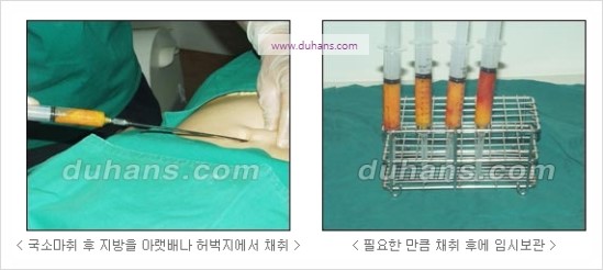 [두한성형외과 경쟁력 코성형] - [코를 높히는 지방이식] 관련 이미지 5