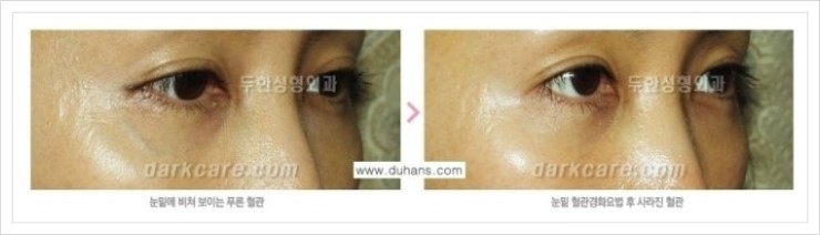 [두한성형외과 경쟁력 눈밑성형] - [눈밑 다크써클 증상과 그 증상에 맞는 치료 방법 안내] 관련 이미지 29