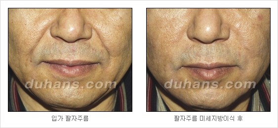 [두한성형외과 경쟁력 주름성형] - [세월의 흔적! 주름을 교정하는 여러 가지 교정 방법] 관련 이미지 29