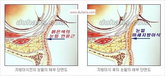 [두한성형외과 경쟁력 안검성형] - [젊은 눈매 안검성형의 여러 가지 방법 안내] 관련 이미지 63