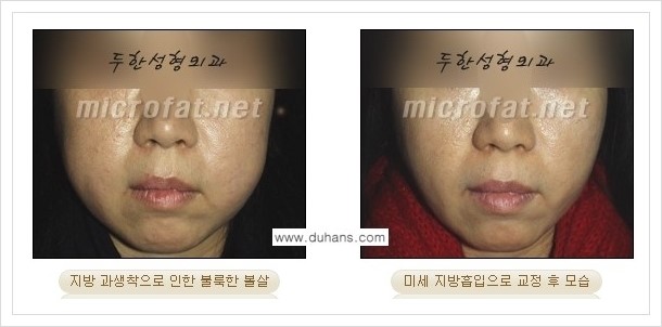 [두한성형외과의 경쟁력 지방이식] - [볼살 지방이식 부작용 -  지방이식 후 과주입으로 인해 불룩해진 경우] 관련 이미지 5