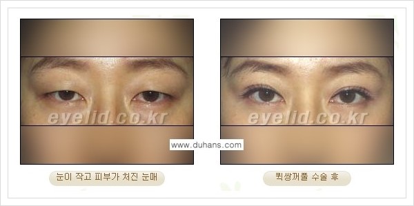 [두한성형외과 경쟁력 눈성형] - [퀵쌍꺼풀 - 부분절개법] 관련 이미지 3