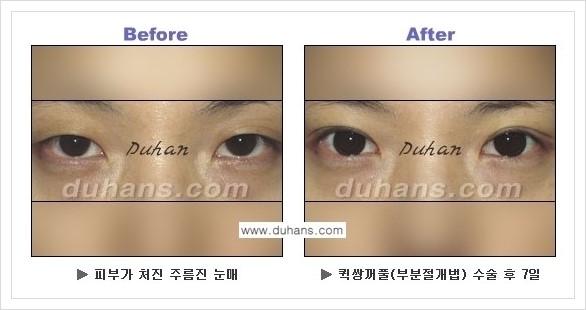 [두한성형외과 경쟁력 쌍꺼풀 재수술, 극한 재수술] - [퀵쌍꺼풀 안내] 관련 이미지 9