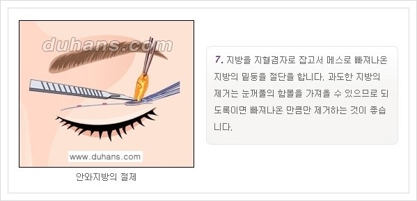 [두한성형외과 경쟁력 눈성형, 쌍꺼풀 수술] - [퀵쌍꺼풀(부분절개법)의 수술 안내] 관련 이미지 8