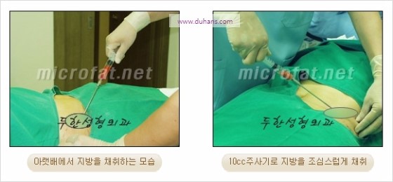 [두한성형외과 경쟁력 윤곽성형] - [볼, 볼살 지방이식] 관련 이미지 6