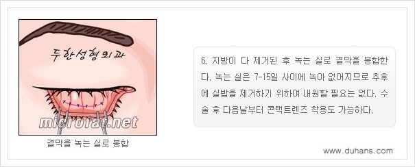 [두한성형외과 경쟁력 눈밑성형] - [눈밑지방제거, 눈위지방제거 안내 1.] 관련 이미지 9