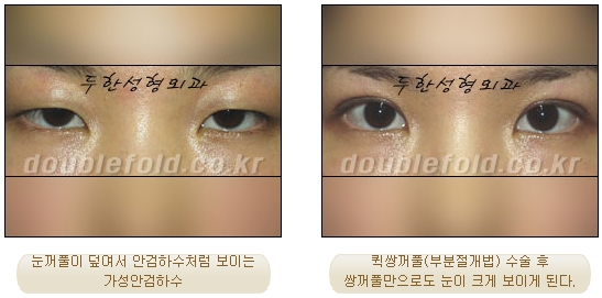 [Duhan Plastic Surgery Double Eyelid Revision Surgery] - [Ptosis, sausage eyelids] image 24