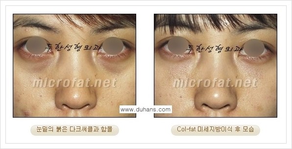 [두한성형외과 경쟁력 눈밑성형] - [눈밑 다크써클과 눈밑 함몰주름의 최적화 교정방법 안내] 관련 이미지 11
