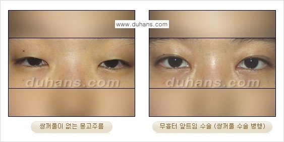 [두한성형외과 NO.1 눈성형] - [몽고주름 제거(앞트임 수술) 2.] 관련 이미지 10