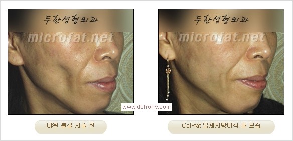 [두한성형외과 Dr. 컬럼] - [콜펫(Col-fat) 지방이식 - 터널링기법, 미세지방이식, 다층지방이식] 관련 이미지 11