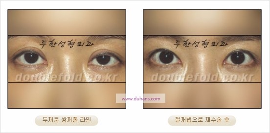 [두한성형외과 경쟁력 눈성형] - [쌍꺼풀 재수술에 대한 최선의 대안 제시] 관련 이미지 10