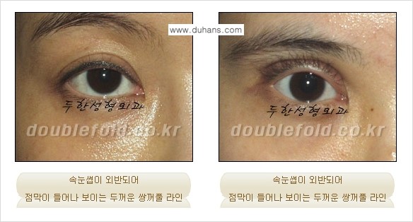 [두한성형외과 경쟁력 쌍꺼풀 재수술, 극한 눈재수술] - [쌍꺼풀 재수술 방법 - 속눈썹 외반] 관련 이미지 9