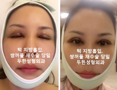 얼굴지방이식 두한성형외과 - 볼지방이식 관련 이미지 51