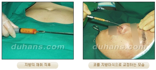 Duhan Plastic Surgery Rhinoplasty - Revision Rhinoplasty Methods image 4