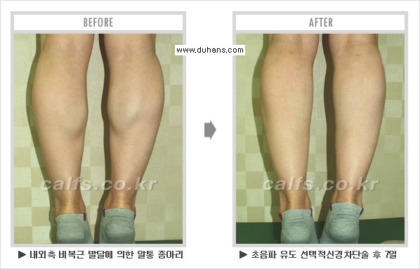 [두한성형외과 경쟁력 멀티종아리성형] - [종아리성형 전후 주의해야 할 내용 안내] 관련 이미지 11