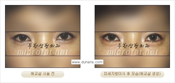 [두한성형외과 경쟁력 눈밑성형] - [눈밑 다크써클과 눈밑 애교살과의 관계 1.] 관련 이미지 6