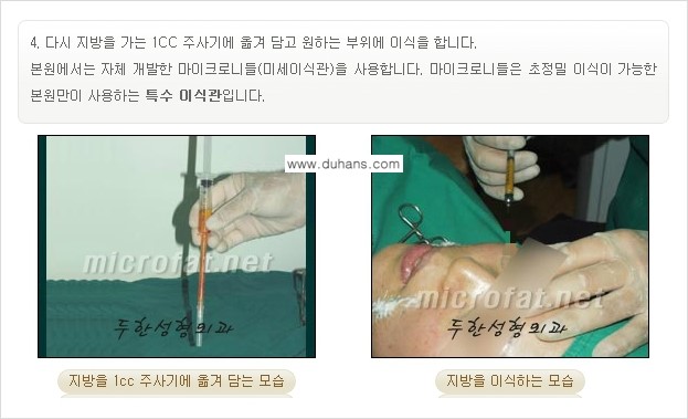 [두한성형외과의 경쟁력 미세지방이식] - [귀족수술과 인디언밴드 미세지방이식 안내 ②] 관련 이미지 10