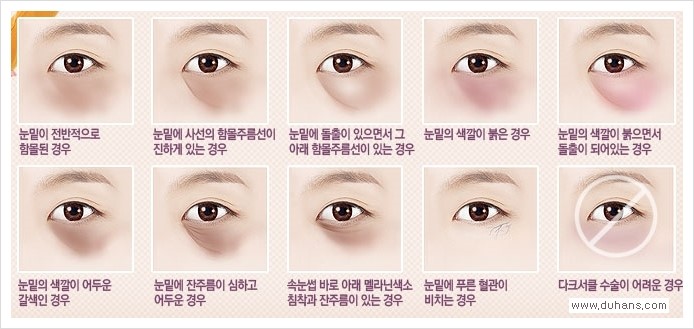 [두한성형외과 경쟁력 눈밑성형] - [눈밑 다크써클과 눈밑 함몰주름의 최적화 교정방법 안내] 관련 이미지 1