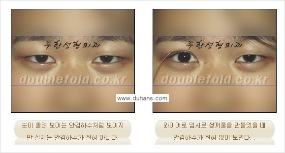 ⁠⁠[두한성형외과 경﻿쟁력 쌍꺼풀 재수술] - [안검하수(졸리운 눈매) 종류와 교정 방법 안내] 관련 이미지 5