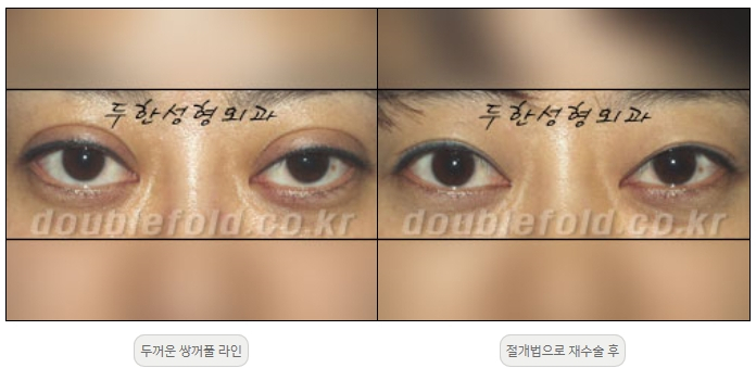 [Duhan Plastic Surgery Double Eyelid Revision] - [Thick Double Eyelid Line] image 13