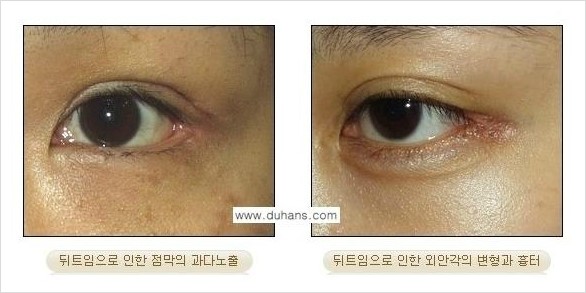 [두한성형외과 경쟁력 쌍꺼풀 재수술, 극한 눈재수술] - [뒤트임 수술의 부작용 및 교정 방법 안내] 관련 이미지 1