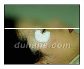 Duhan Plastic Surgery Wrinkle Improvement - Wrinkle Fillers, Juvederm image 7