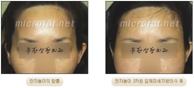 Fat Grafting Leader Duhan Plastic Surgery - Everything About Fat Grafting image 8