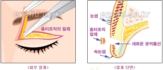 [두한성형외과 쌍꺼풀재수술] - [쌍꺼풀재수술성공요건, 쌍꺼풀재수술과정] 관련 이미지 4