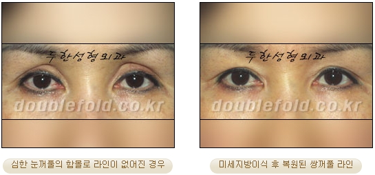 [두한성형외과 쌍커풀수술] - [눈성형 방법에 대한 자주하는 질문과 답변] 관련 이미지 105
