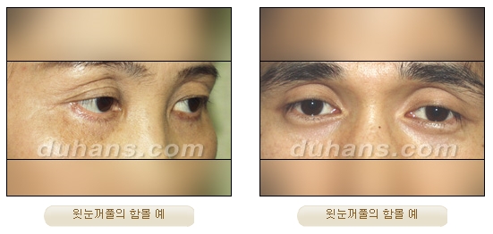 [Duhan Plastic Surgery Micro Fat Grafting] - [Upper Eyelids] image 1