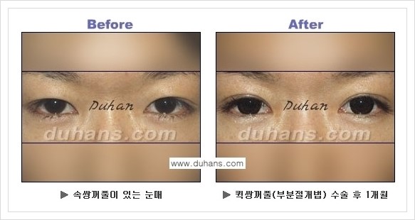 [두한성형외과 경쟁력 눈성형] - [퀵쌍꺼풀 수술 전후 정보 안내 ②] 관련 이미지 1