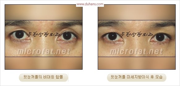 [두한성형외과 경쟁력 눈성형 리더] - [윗눈꺼풀 함몰( #꺼진눈꺼풀) 미세지방이식과 상안검성형]#꺼진눈성형 , #눈위함몰 관련 이미지 33