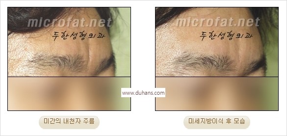 [두한성형외과 경쟁력 동안성형 리더] - ​[미간주름, 이마주름, 안검성형, 이마거상술, 눈썹거상술] 관련 이미지 13