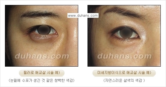 [두한성형외과 경쟁력 미세지방이식] - [눈밑 애교살을 위한 미세지방이식 1.] 관련 이미지 13